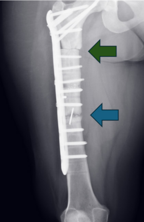 Hyperbaric Oxygen Promotes Fracture Healing in Patients with Pycnodysostosis