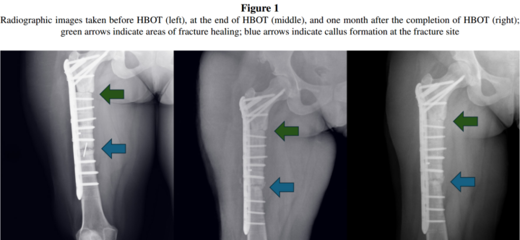 Hyperbaric Oxygen Promotes Fracture Healing in Patients with Pycnodysostosis