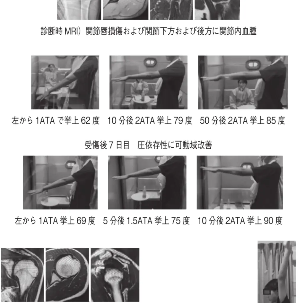 Rapid Return to the Field: Hyperbaric Oxygen Therapy Combined with Rehabilitation for Joint Injuries case1