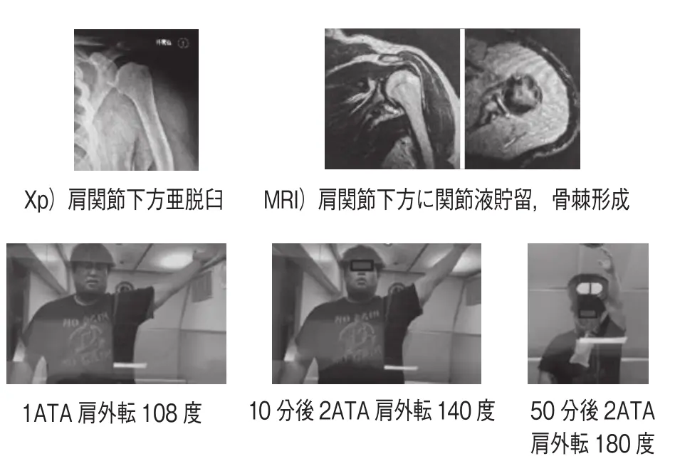 Rapid Return to the Field: Hyperbaric Oxygen Therapy Combined with Rehabilitation for Joint Injuries case2