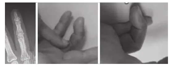 Rapid Return to the Field: Hyperbaric Oxygen Therapy Combined with Rehabilitation for Joint Injuries case3