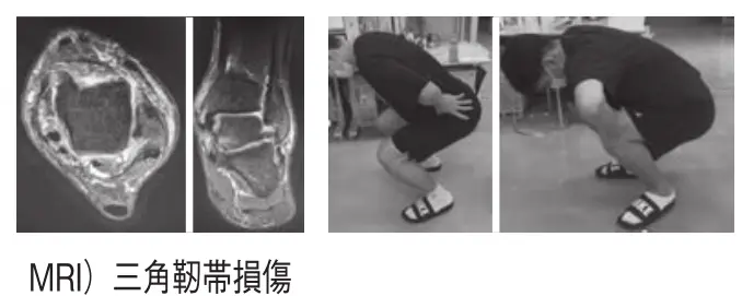 Rapid Return to the Field: Hyperbaric Oxygen Therapy Combined with Rehabilitation for Joint Injuries case4