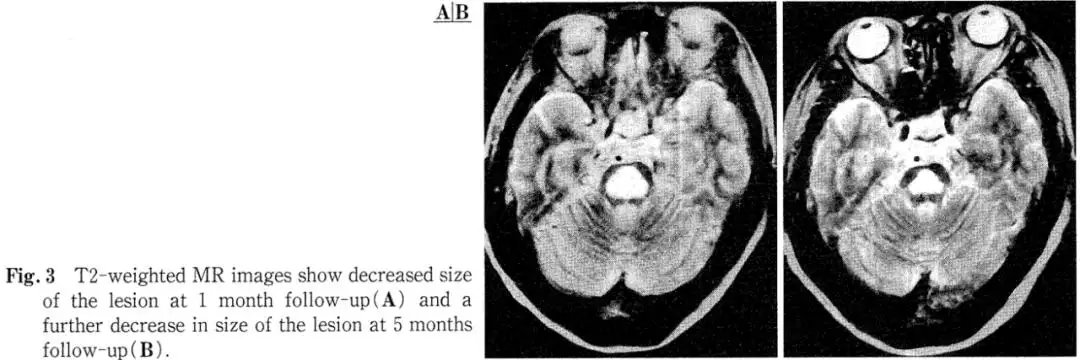 Hyperbaric Oxygen Therapy in Central Pontine Myelinolysis
