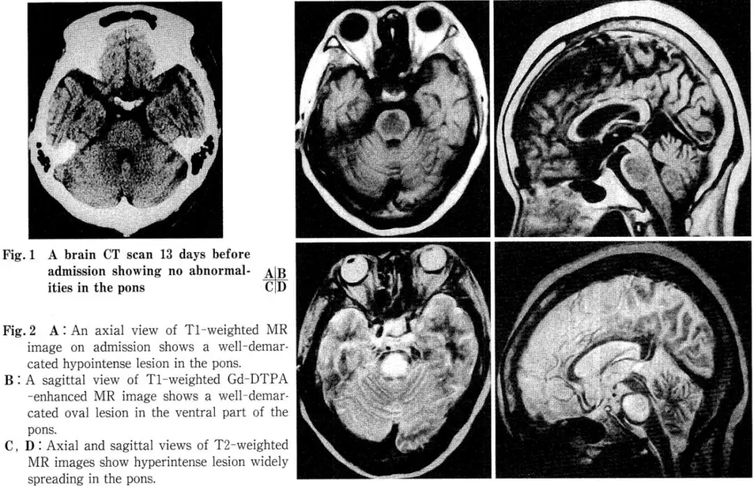Hyperbaric Oxygen Therapy in Central Pontine Myelinolysis