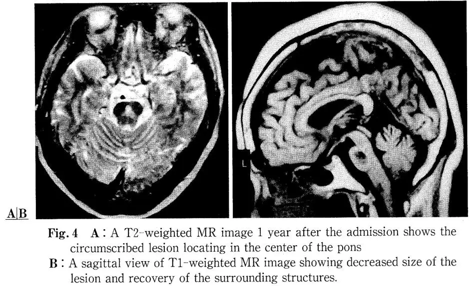 Hyperbaric Oxygen Therapy in Central Pontine Myelinolysis